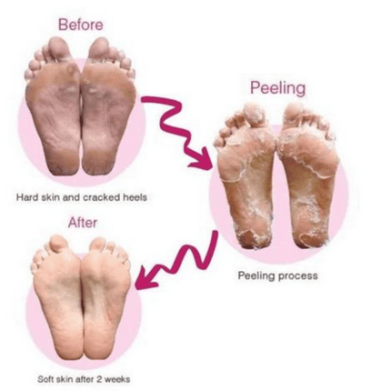 Bathefex SoftSole Express Exfoliating Foot Peel - Renew Your Feet