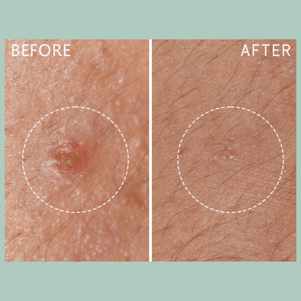 Lierac PROTOCOL - ANTI-BLEMISH - The Stop Spots 15ml