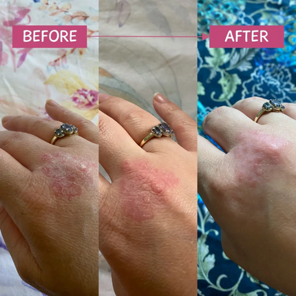 MooGoo Pink Eczema Cream 120g